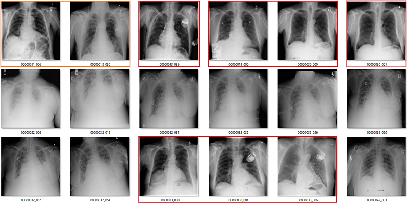 рентгеновские снимки легких